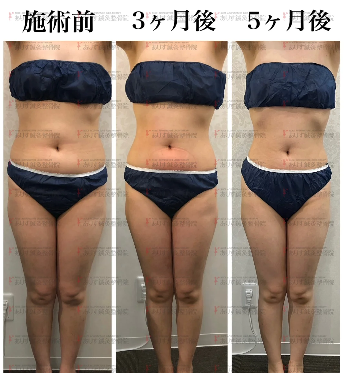 高松市で痩身なら！脂肪冷却でリバウンドなしのスピードダイエット